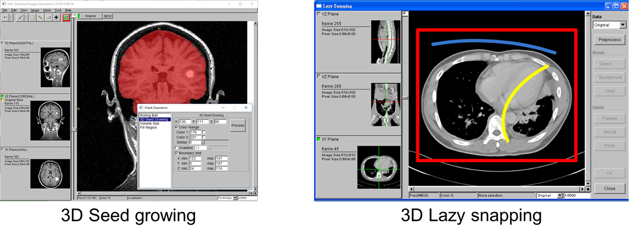 3D Seed growing與3D Lazy snapping