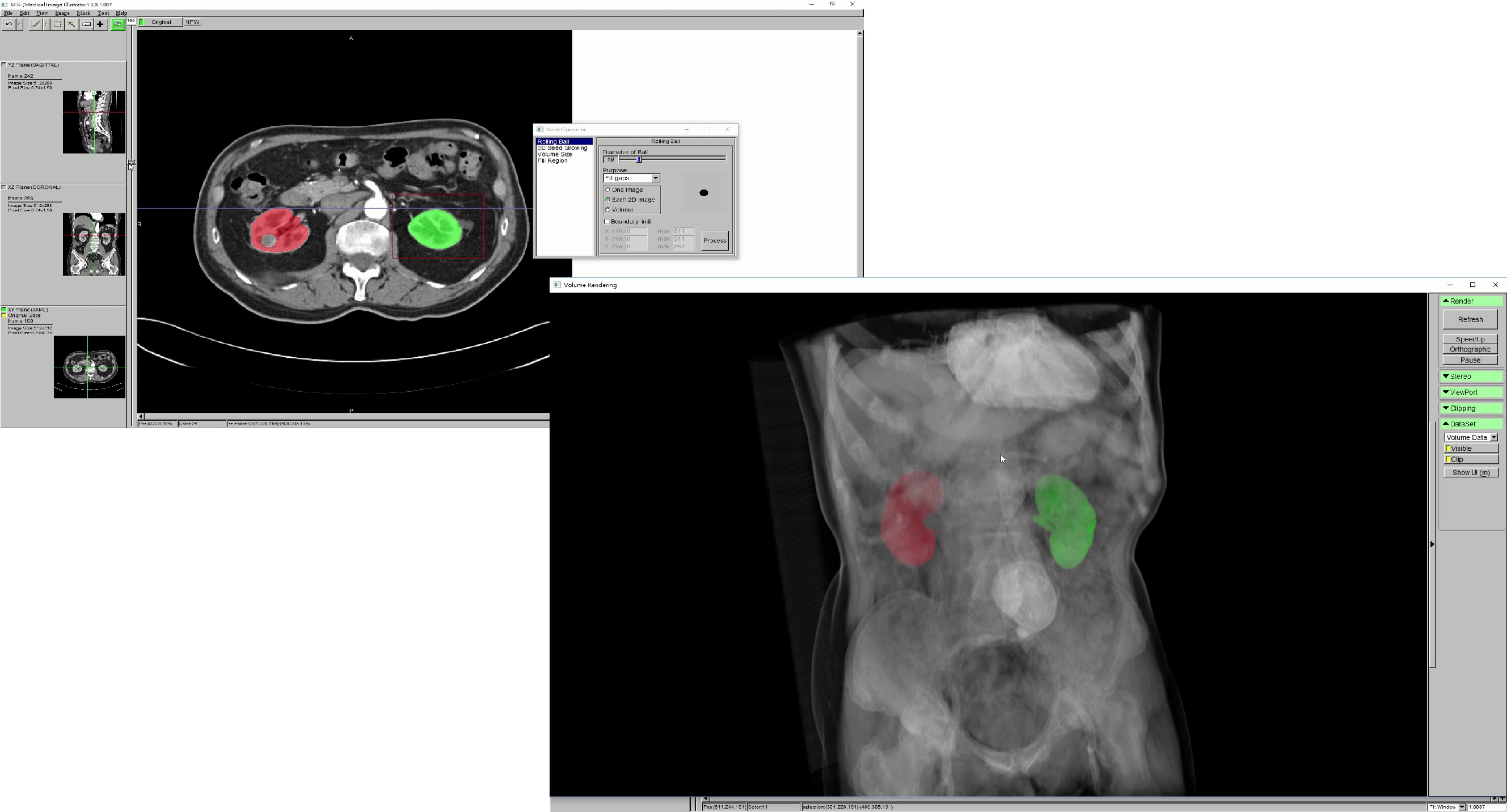 三維醫療影像標記處理軟體MiiL